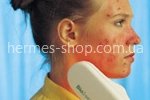 Аппарат для лечения акне (угри,прыщи) BioBeam Acne Аппарат для лечения акне (угри,прыщи) BioBeam Acne